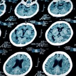 Brain MRI-Alzheimer's