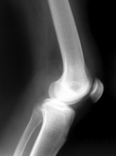 knee-x-ray-2-391481-m