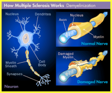 multiple-sclerosis-demyelinization.gif