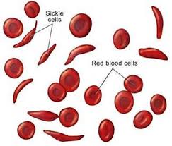 red blood cells:sickle
