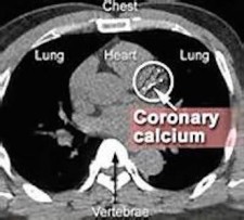 Coronary Calcium scan