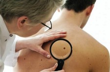 having-more-then-11-moles-on-right-arm-is-one-of-melanoma-skin-cancer-symptoms