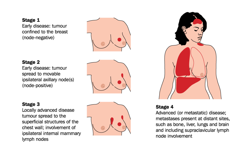 Surgery Improves Survival For Advanced Breast Cancer Patients