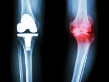 osteoarthritis via shuttterstock