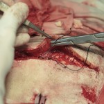 craniotomy via shutterstock
