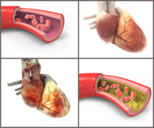 Heart disease via Shutterstock