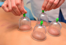 Cupping Therapy, via Shutterstock