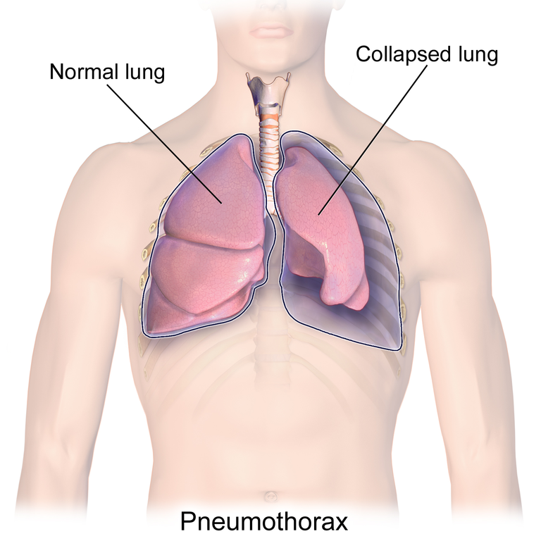 JUUL Blamed For Collapsed Lung American Council On Science And Health