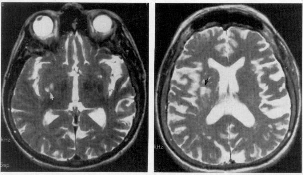 anosognosia-can-you-treat-someone-who-doesn-t-accept-they-are-ill