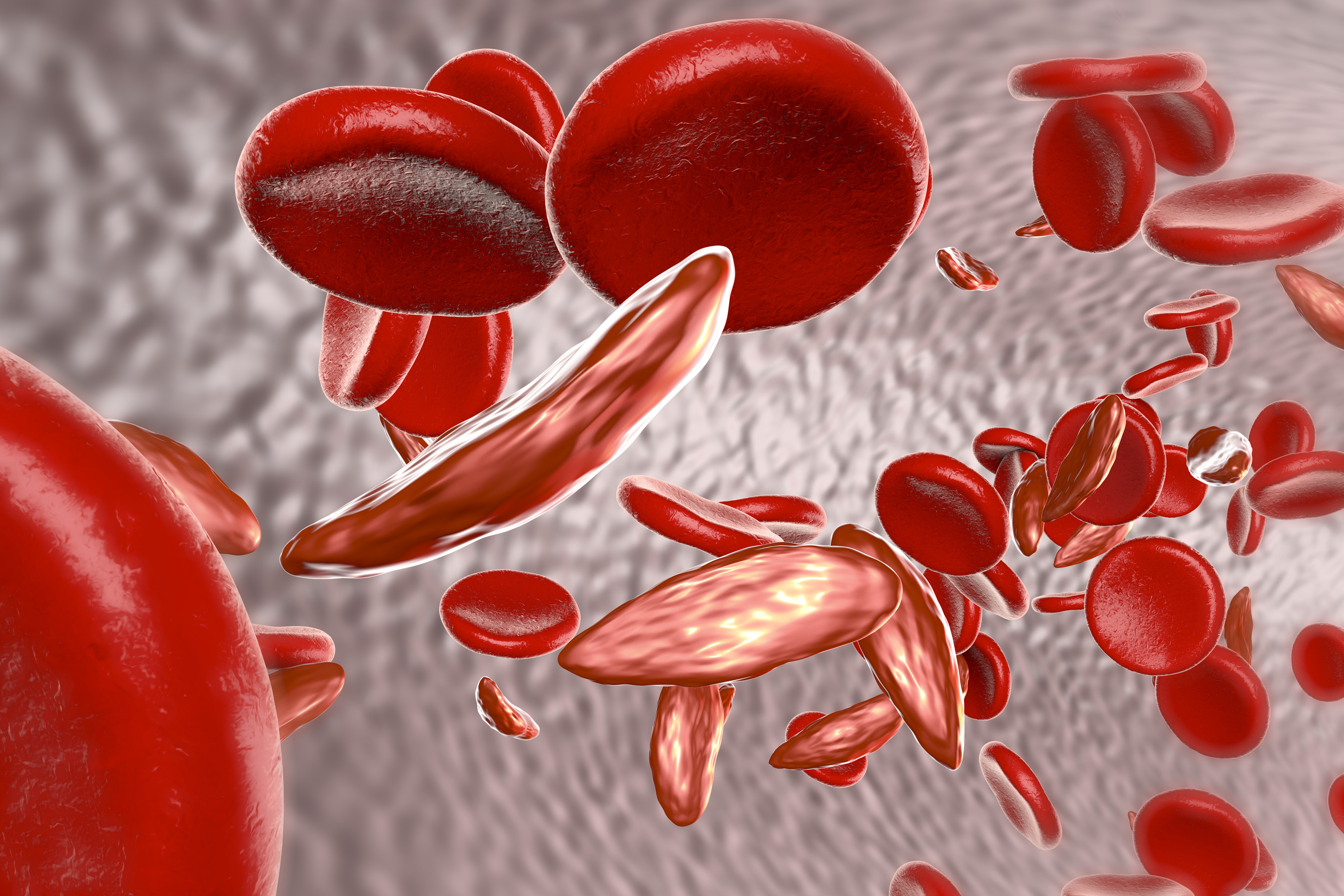 Did Gene Therapy Cure Sickle Cell Disease American Council On 